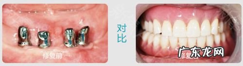 过来人说出真相 种植牙后疼痛怎么回事
