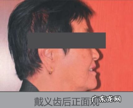 「牙齿那些事儿」No.20 种植金属牙不能做什么