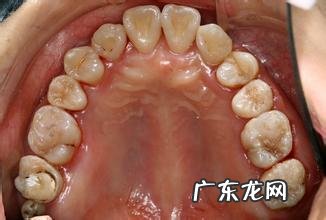 「牙齿那些事儿」No.20 种植金属牙不能做什么