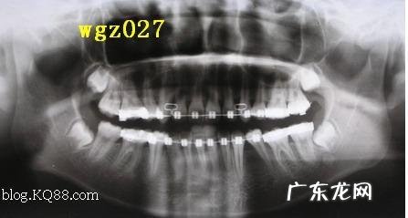 「牙齿那些事儿」No.20 种植金属牙不能做什么