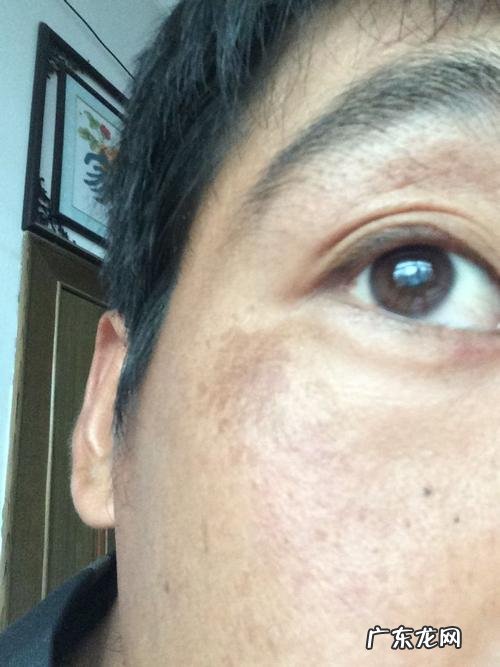 种植牙暂不纳入医保范围 种植牙牙齿缺失怎么办