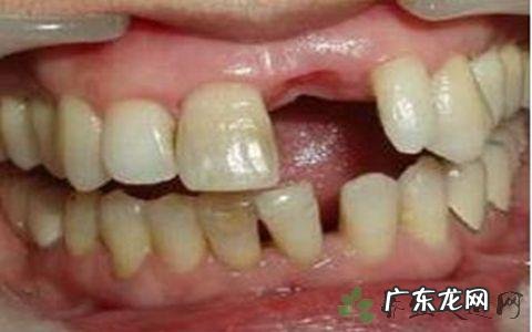 种植牙暂不纳入医保范围 种植牙牙齿缺失怎么办