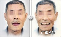 专家给出客观分析 没有牙根了除了种植还能怎么办