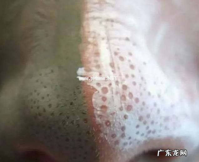 鼻子上挤出的白色物体到底是什么吗