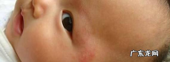 婴儿干性湿疹的预防与治疗