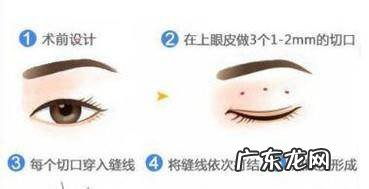 做双眼皮手术多久才能恢复