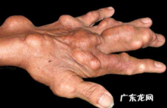 肥胖的人得痛风瘦下来能好么 为什么胖的人一瘦下来就痛风