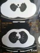 肺部有白点问题大不大？医生告诉你：这2类人最好去医院看看!