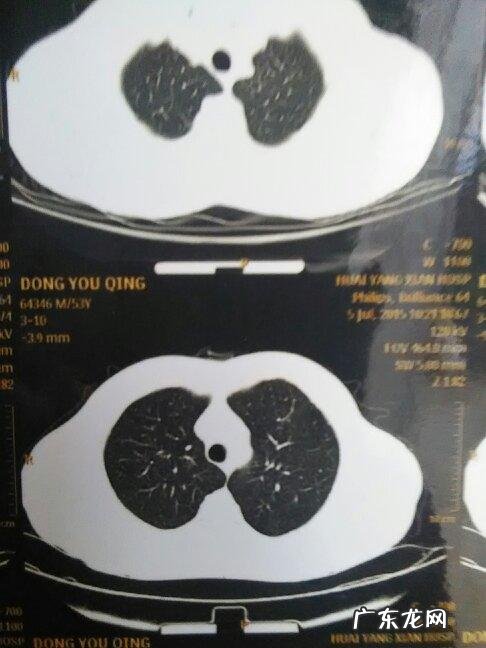 肺部有白点问题大不大?医生告诉你:这2类人最好去医院看看!