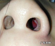 鼻子里总破是什么原因？鼻子总是破是怎么回事？