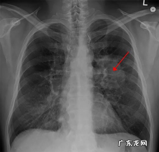 肺部有阴影是咋回事?肺部的阴影是怎么形成的?