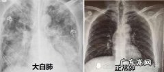 白肺意味着什么？白肺的临床表现有哪些？