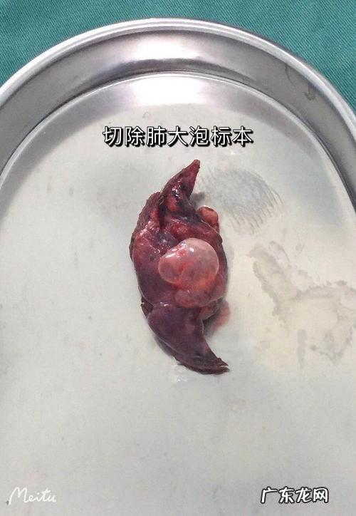 肺大泡怎么形成的?