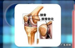 髌软骨软化症如何诊断？怎么治疗呢？