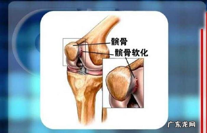 髌软骨软化症如何诊断？怎么治疗呢？
