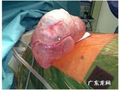肺大泡是怎样形成的？如何治疗？