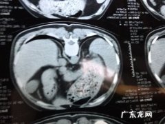 肺部有黑点是什么病？如何确诊？