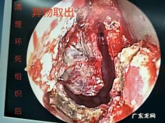我的鼻子里总感觉有异物是怎么回事？