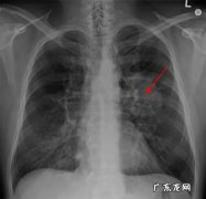 肺部阴影是什么病？