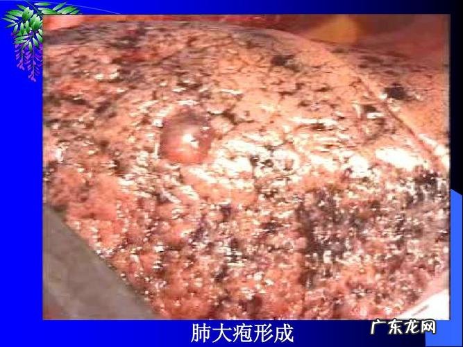 肺大泡形成是什么意思?