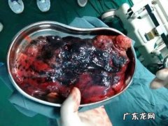 肺部有黑块是怎么回事？如何检查出来？