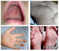 5岁以下婴幼儿容易引发手足口病,家长们要重视了