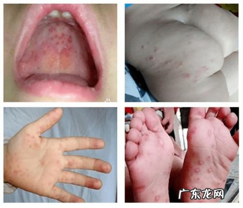 5岁以下婴幼儿容易引发手足口病,家长们要重视了