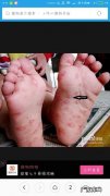 宝宝手足口病怎么引起的？宝宝患了手足口病怎么办？