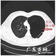 肺上有肺大泡是怎么回事？如何治疗和预防？