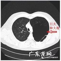 肺上有肺大泡是怎么回事?如何治疗和预防?