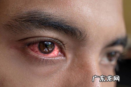 眼睛充血的原因及缓解方法
