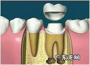 什么是牙齿根管治疗就属薄荷牙博士 什么是牙齿根管治疗