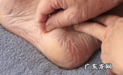 脚后跟干裂起硬皮用什么泡脚好 脚后跟硬皮用什么泡