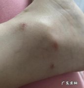 猫咪被跳蚤咬过后结痂图!
