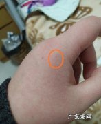 孩子被猫抓了,轻微破皮要去医院打针吗？家长们看看!