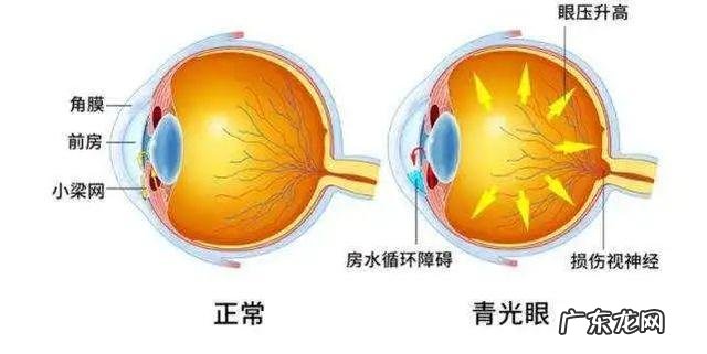 青光眼的症状和表现是什么白内障 青光眼的症状和表现是什么