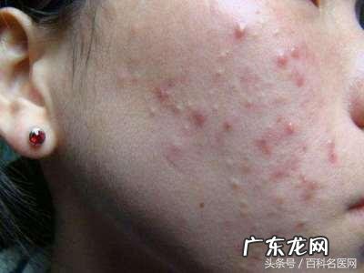 肝火旺会出现什么症状怎么调理 肝火旺会出现什么症状