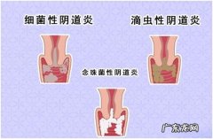 霉菌性阴炎的症状用什么药效果好图片 霉菌性阴炎的症状用什么药效果好
