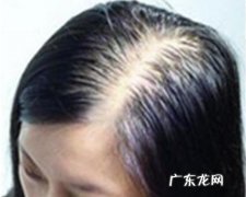掉头发严重是什么原因女性缺什么 掉头发严重是什么原因女性