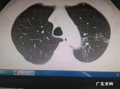 干咳无痰是肺结核吗 肺结核没痰是好事吗