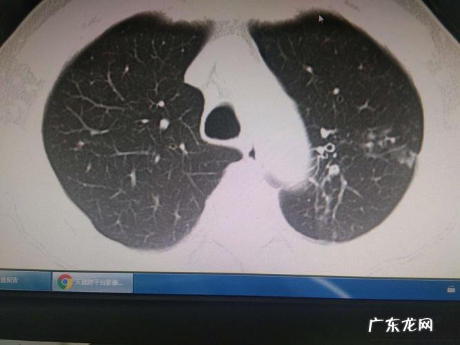 干咳无痰是肺结核吗 肺结核没痰是好事吗
