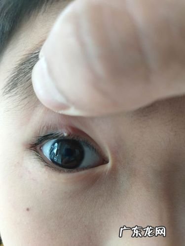 有没有得过外麦粒肿的朋友 麦粒肿多久能完全消退