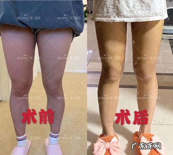 抽大腿脂肪多少钱 大腿抽脂肪多少钱一次