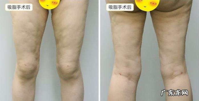 大腿抽脂是什么样的体验 抽脂是什么样的一个手术过程