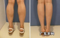 打瘦腿针一般多久有效果 瘦腿针200u一次打两只腿够吗