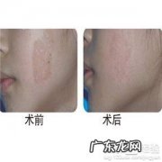 去除咖啡斑的方法有哪些啊 中医祛除咖啡斑的方法有哪些