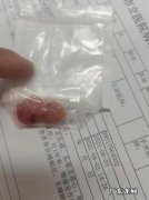 做一次扁桃体切除手术的费用是多少 扁桃体手术的费用是多少