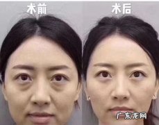 怎样才能消除眼袋 女人眼袋大怎么消除