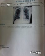 什么是陈旧性肺结核 陈旧性肺结核会癌变吗