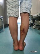打了瘦腿针多久见效 瘦腿针打了多久见效